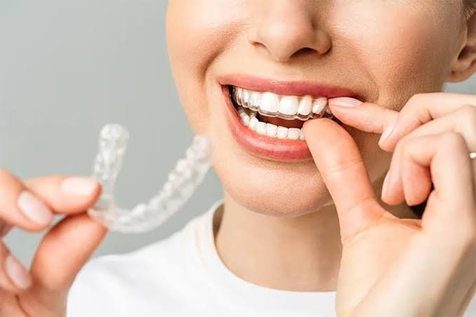 Primer plano de dientes con un alineador transparente GET ALIGNED, casi imperceptible