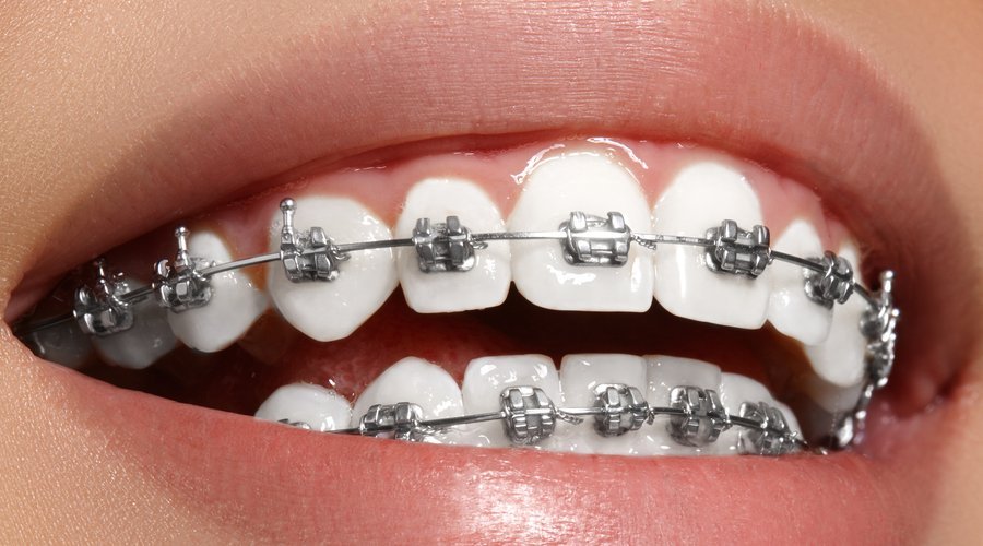 Primer plano de dientes con brackets metálicos y alambre